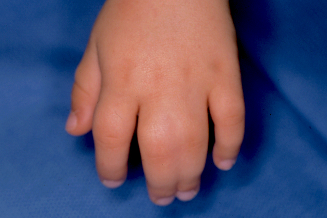 Syndactyly Observation Hand Surgery Resource